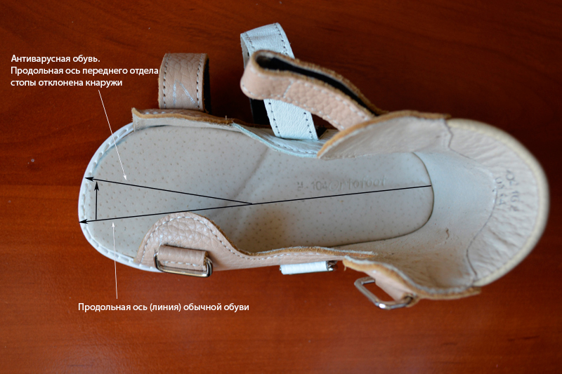 Аниварусная обувь Ortofoot для лечения косолапия